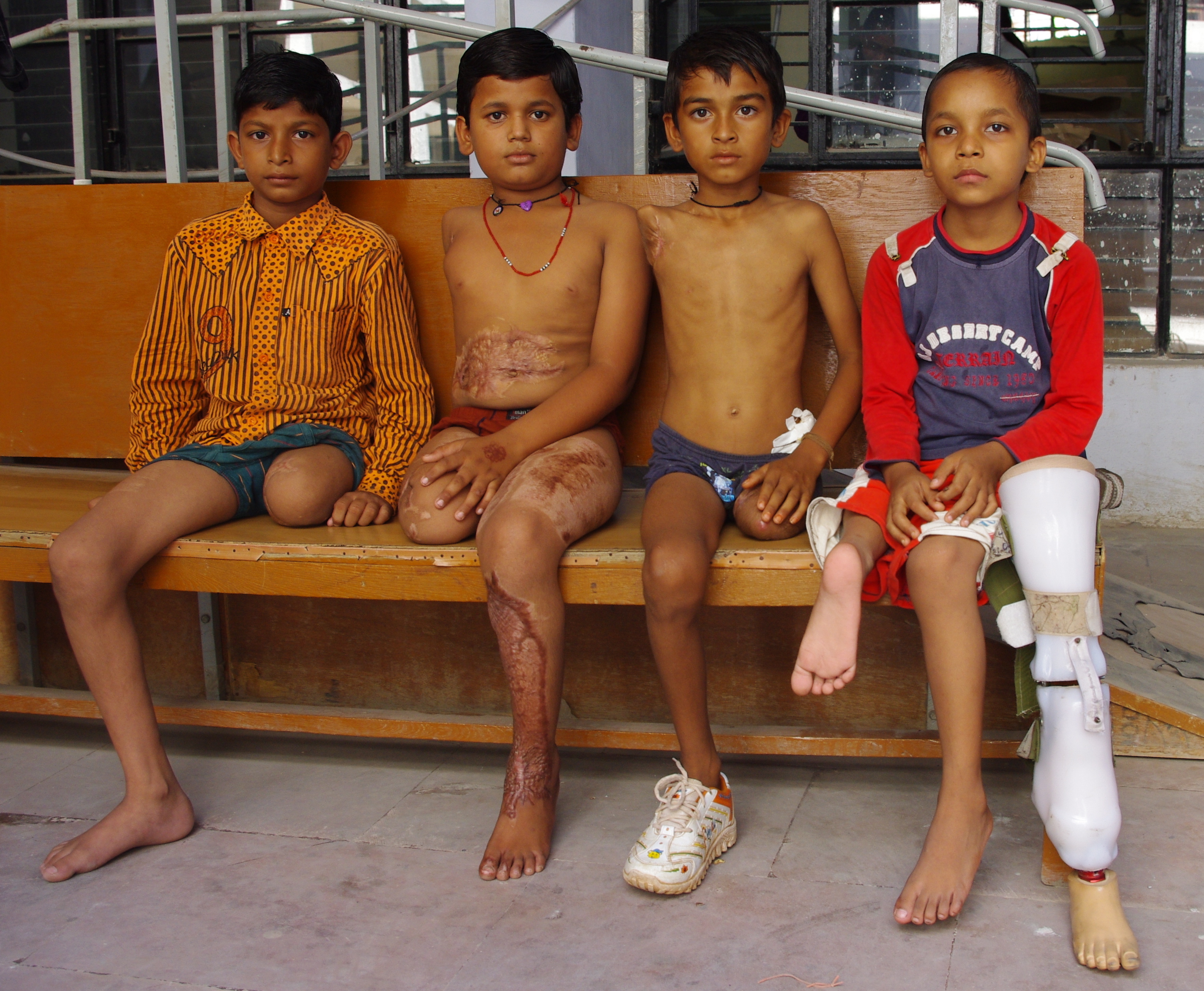Give 40 Children in Asia the Ability to Walk!