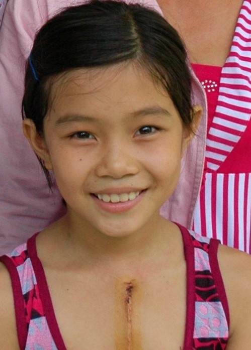 Life-Changing Heart Surgeries for Kids in Vietnam