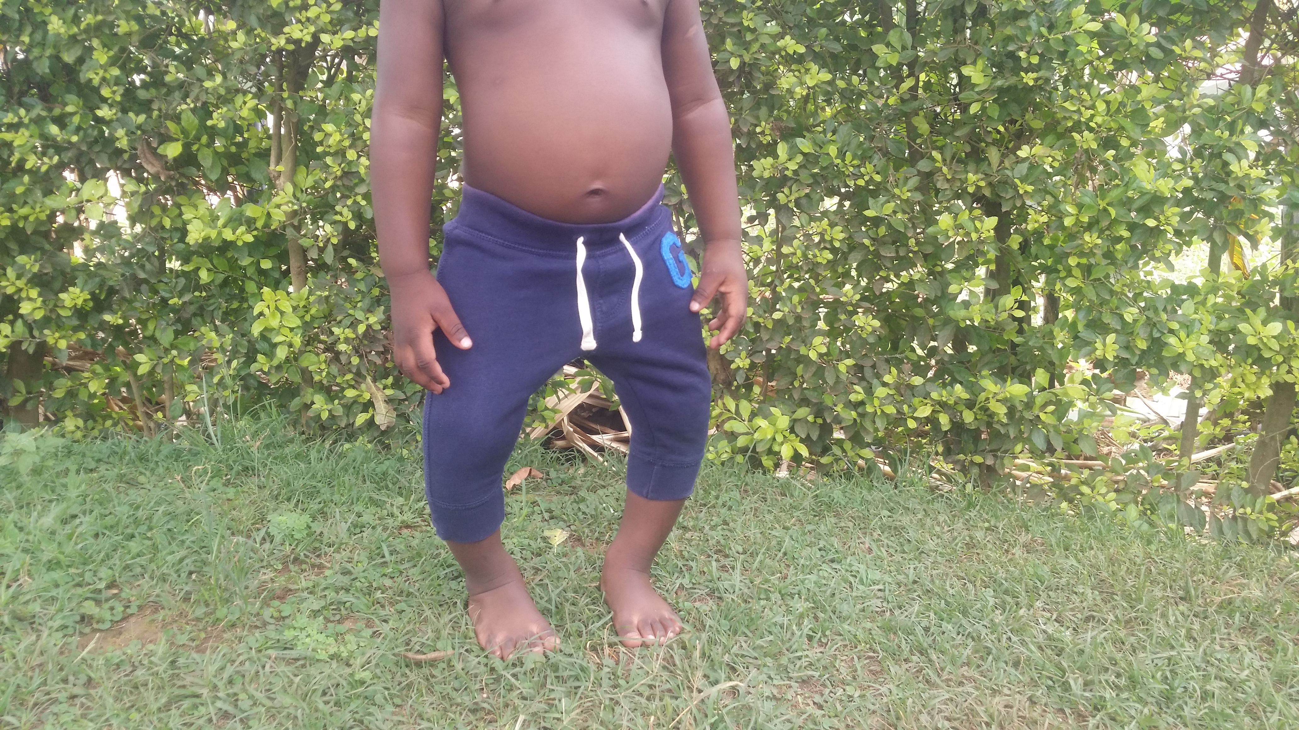 Help correct baby Eli's bowed legs in Uganda