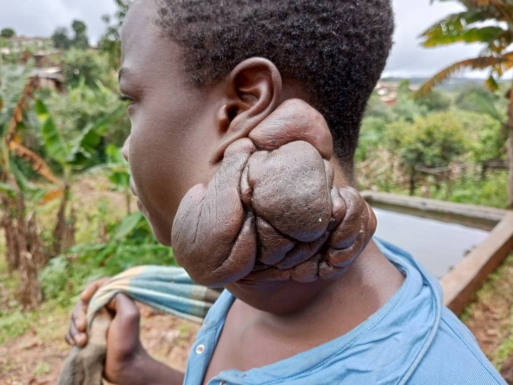Fund Surgery and Education for 3 Orphans in Kumbo.