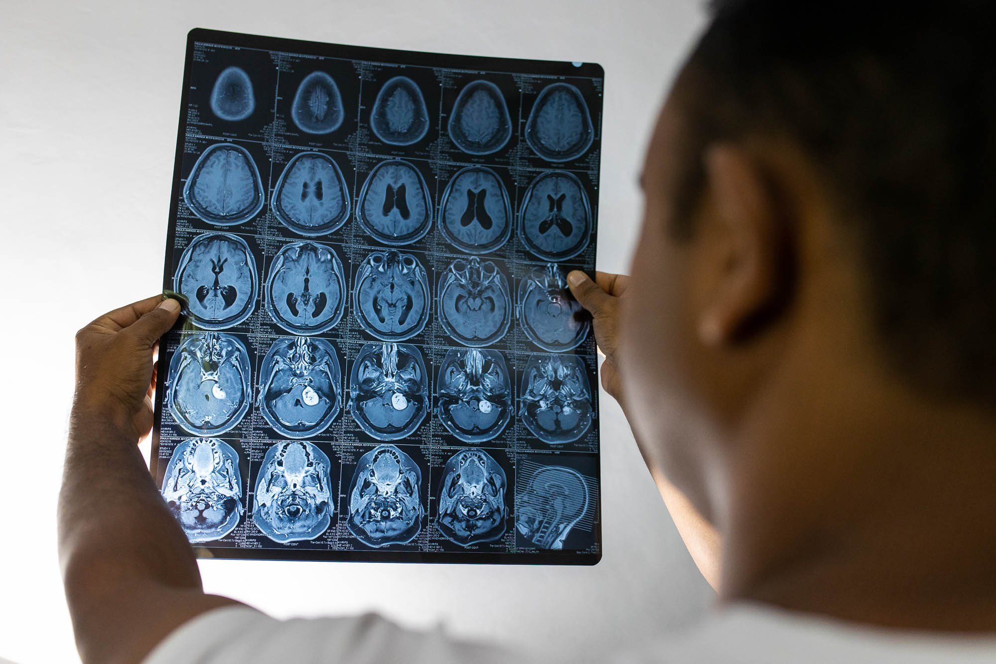 Life Saving Brain Surgery For Mission Staff Member