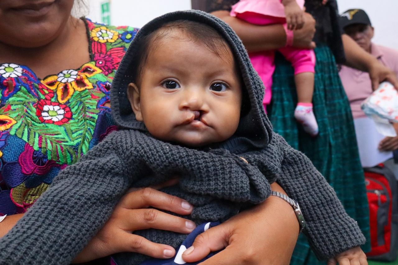 Support Cleft Nutrition in Rural Guatemala