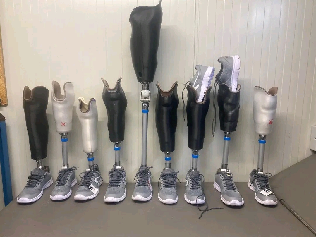 Help Disabled Congolese Walk with 3D Limbs