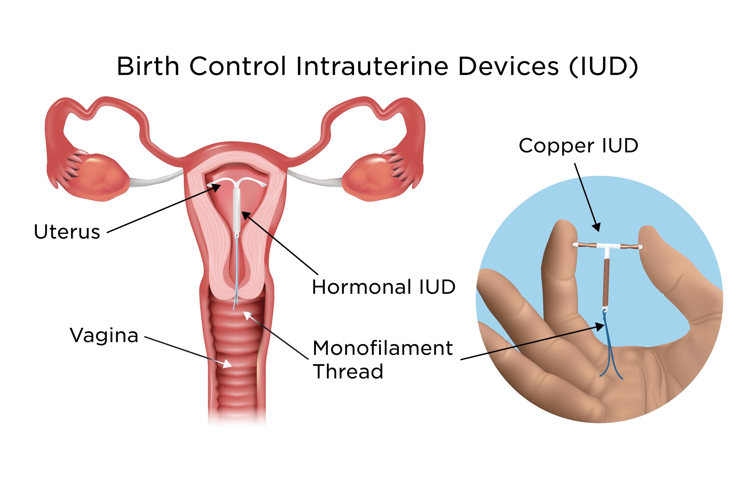 IUDs & Implants: Birth Control for 900 Rural Women