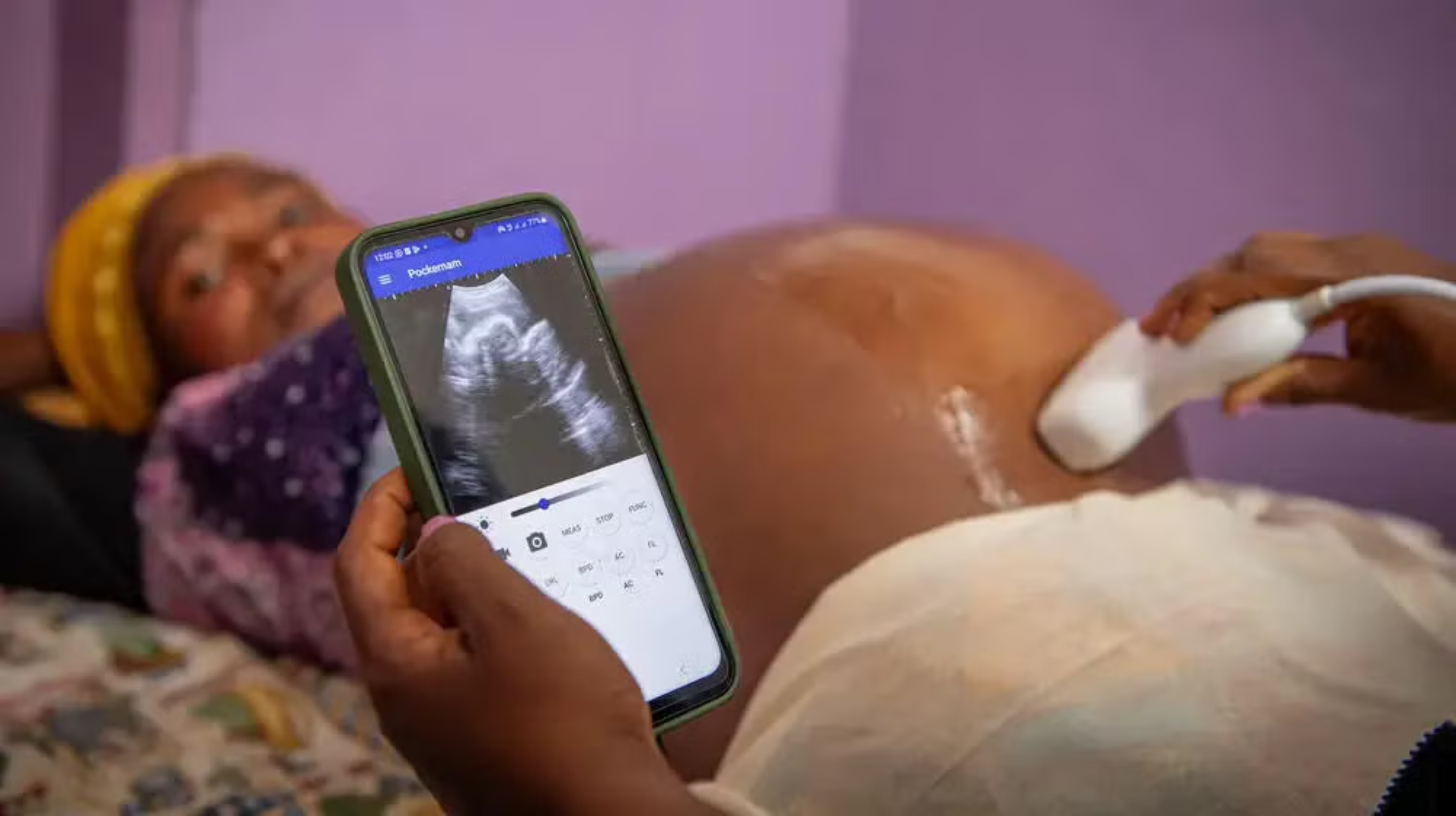 Phone-Based Ultrasounds for 500 Rural Hospitals