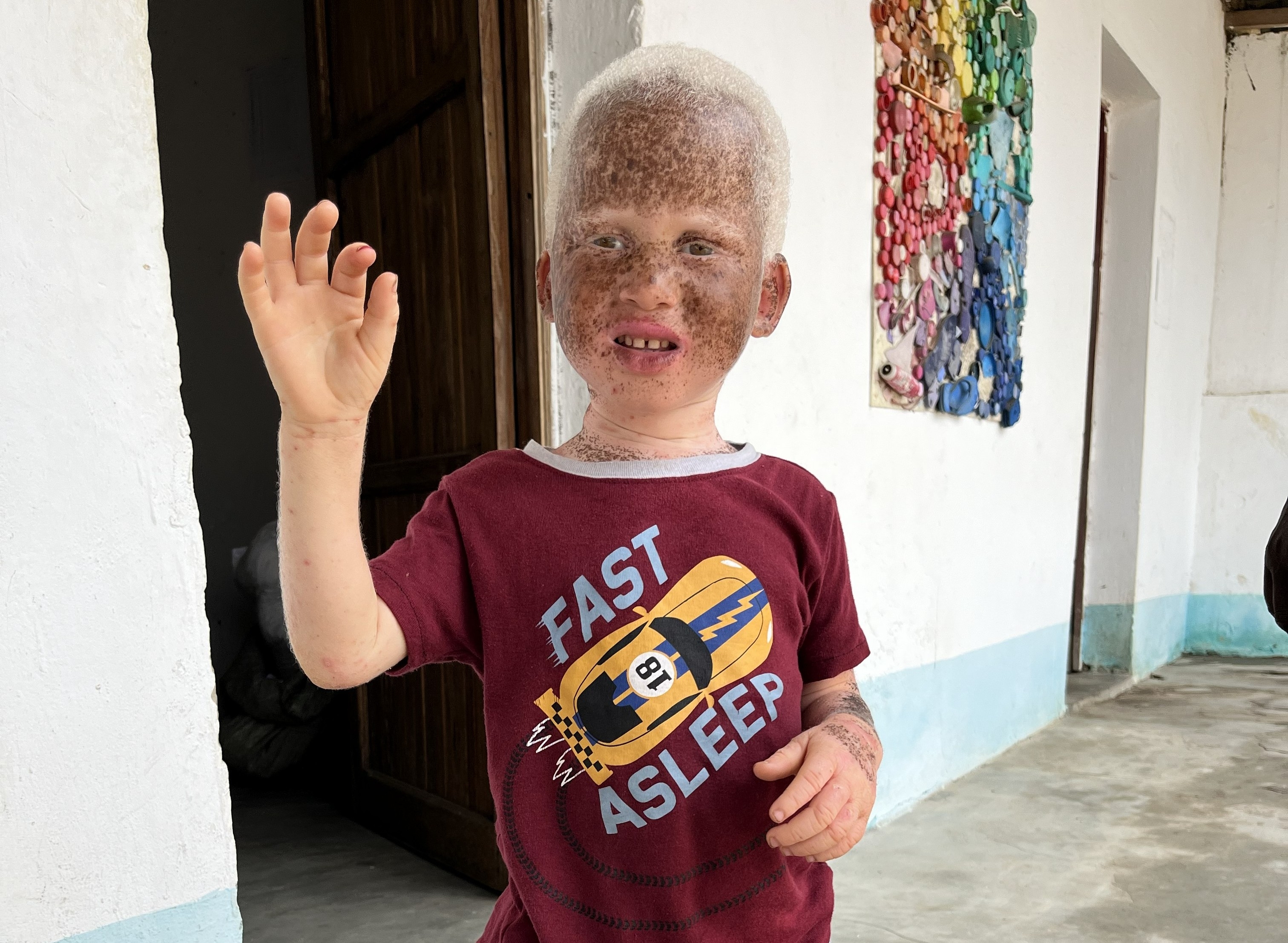 Luz - Sunscreen for Children with Albinism
