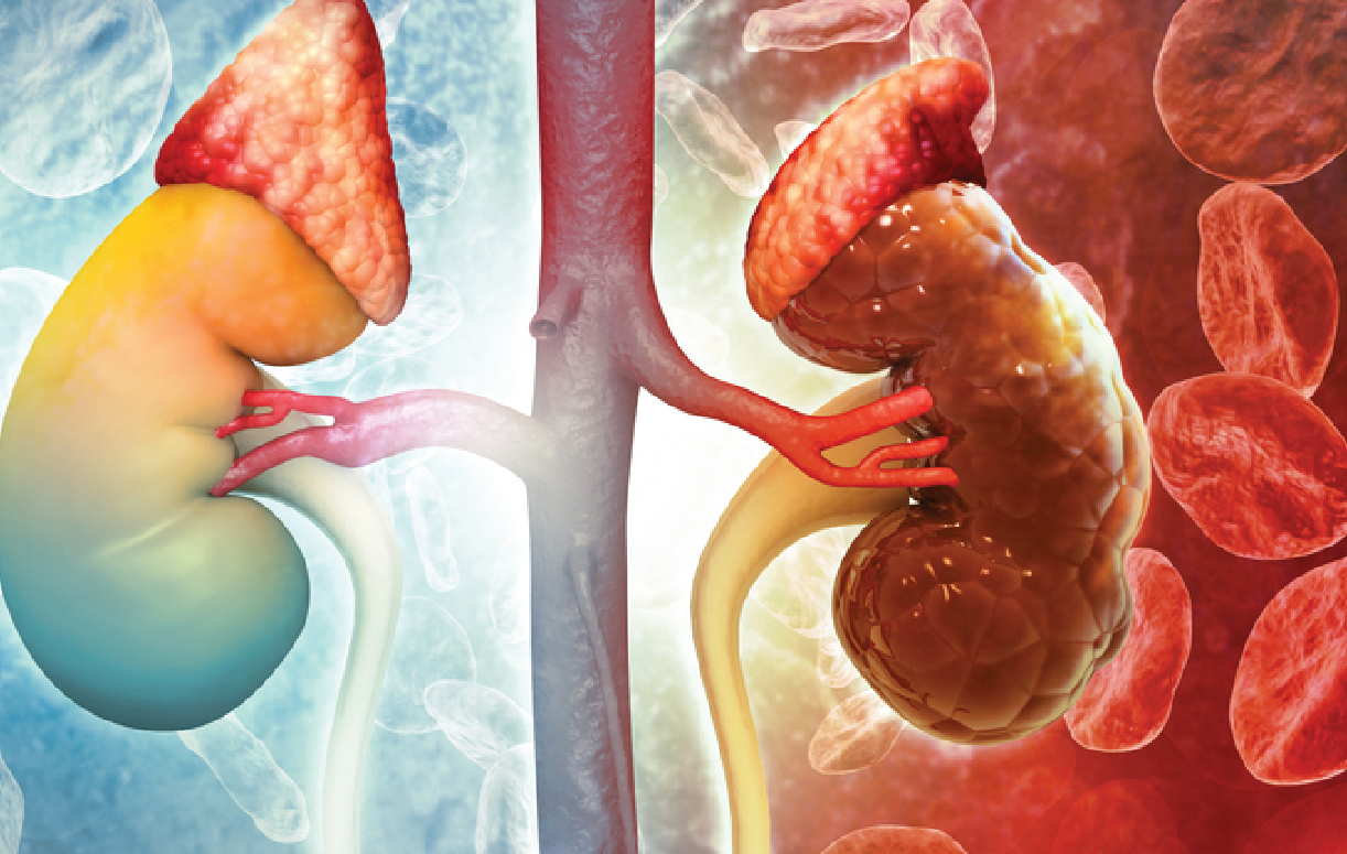 Prevention of Kidney Diseases in Nigeria