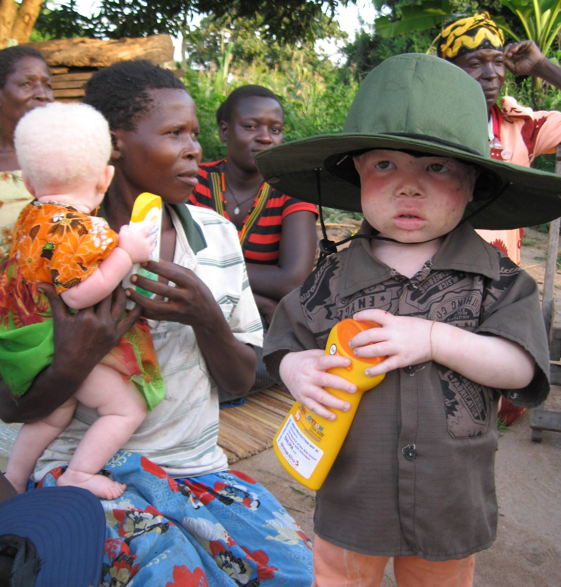 Protecting Women & Children with Albinism