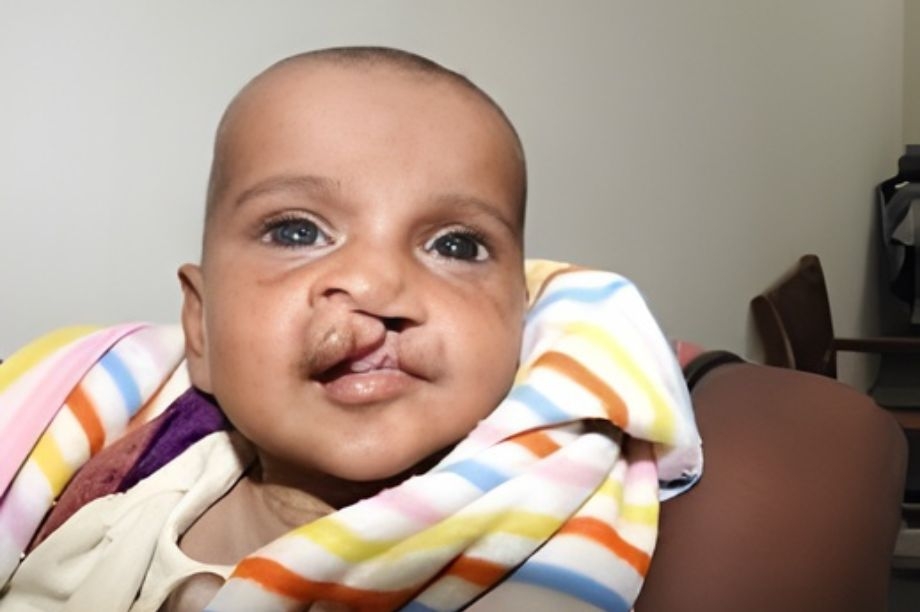 Transforming Lives: Cleft Surgery in Pakistan