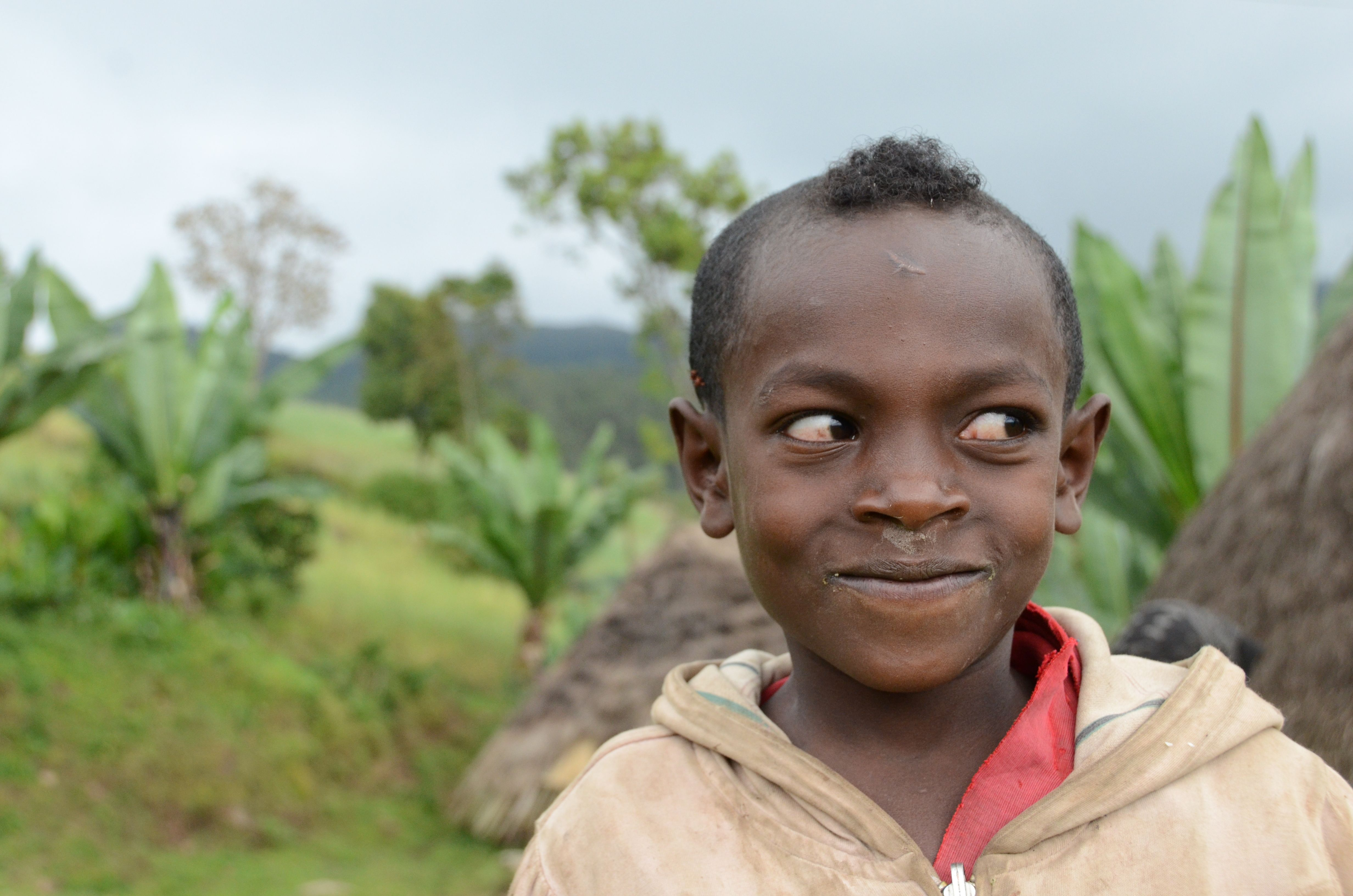 Simple Surgery to Restore Sight in Ethiopia